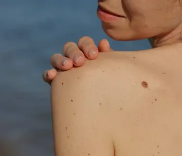 Doctor examinando la piel de una paciente en una consulta médica.